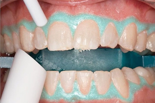 牙齿美白照灯模型示意图