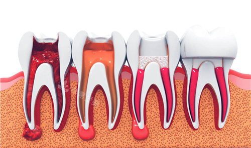 牙科根管治疗过程图