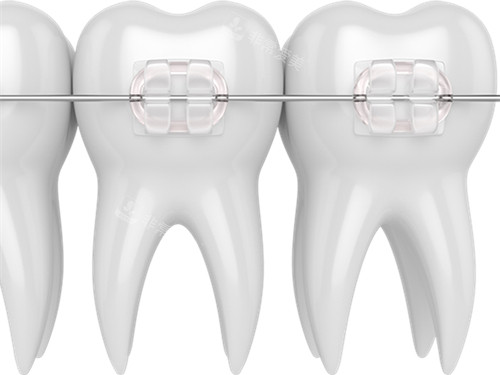 牙齿矫正透明托槽示意图