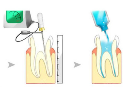 根管治疗操作步骤
