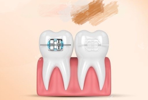 牙齿矫正金属和陶瓷托槽漫画图