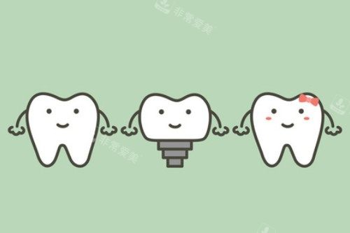 单颗种植牙卡通展示图