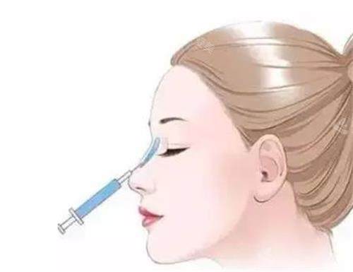 液态隆鼻的部位