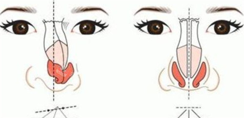 鼻梁矫正对比