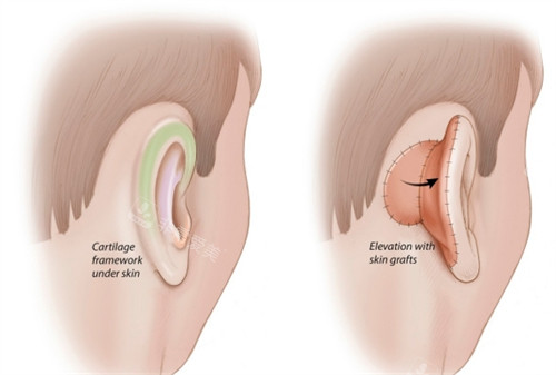 术前焦虑值90%→术后自信度200%:我的韩国耳修复120天身心实录