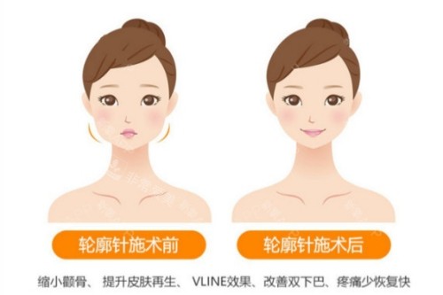 轮廓针卡通对比图