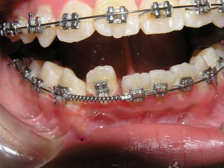 牙齿矫正正畸推簧口内展示图