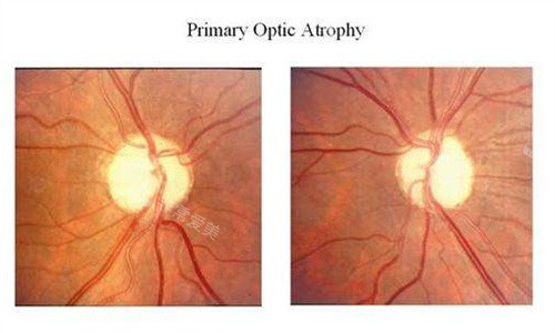 视神经萎缩的眼底
