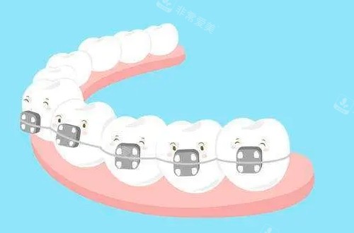 传统牙齿矫正器动画展示图