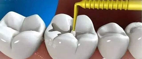 补牙治疗过程示意图
