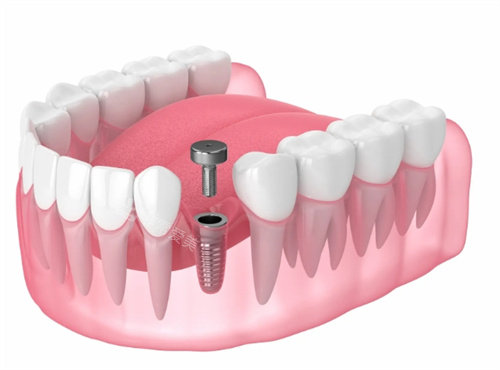 种植牙愈合基台透视动画