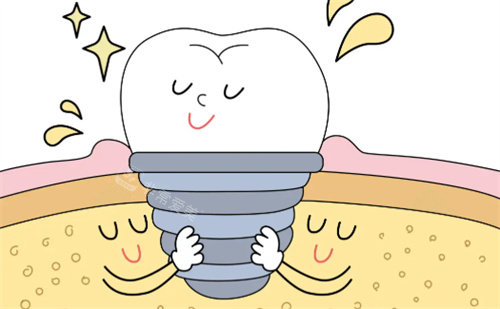 种植牙卡通展示图片