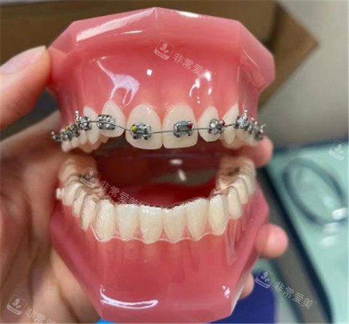 金属托槽矫正牙模
