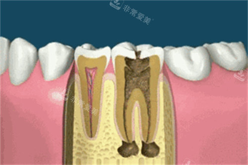 种植牙卡通展示图