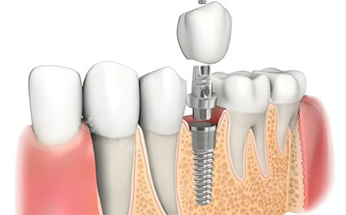 种植牙材料展示