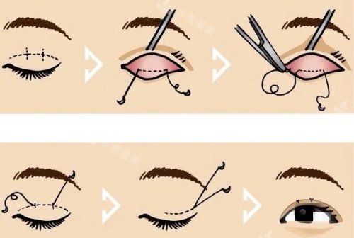 雙眼皮操作示意圖 雙眼皮操作示意圖
