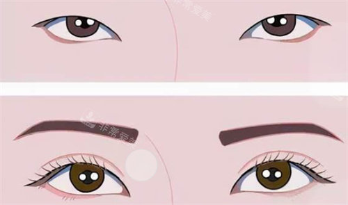 雙眼皮前后對比 雙眼皮前后對比