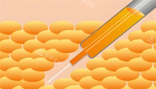 吸脂手术图 吸脂手术图