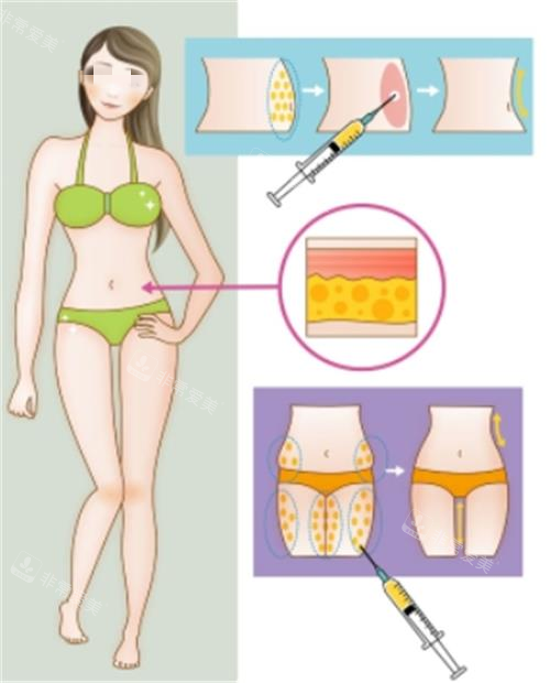全身吸脂部位示意图 全身吸脂部位示意图