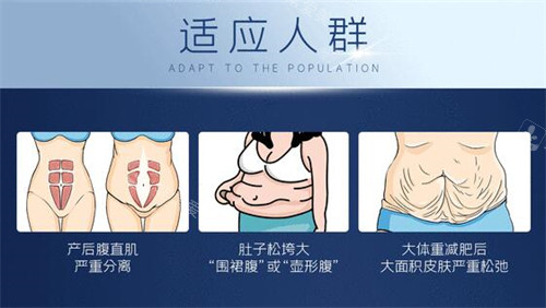 腹壁成形手术适合的人群 腹壁成形手术适合的人群