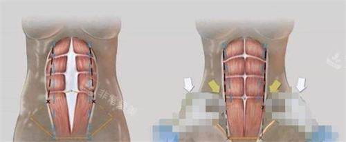 美人鱼腹壁成形术的过程 美人鱼腹壁成形术的过程