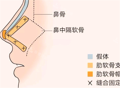 隆鼻形态 隆鼻形态