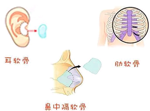 隆鼻手术 隆鼻手术