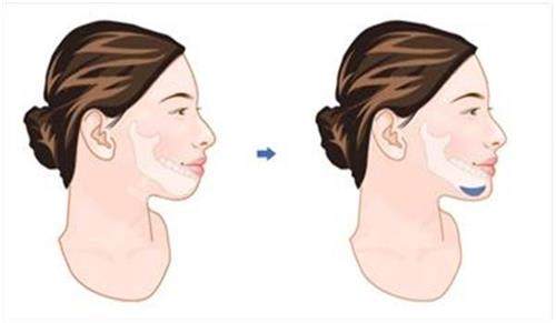 垫下巴前后对比 垫下巴前后对比