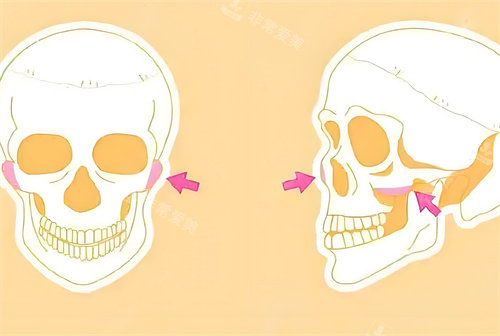 顴骨手術(shù)磨骨部位骨頭演示動(dòng)畫(huà)圖