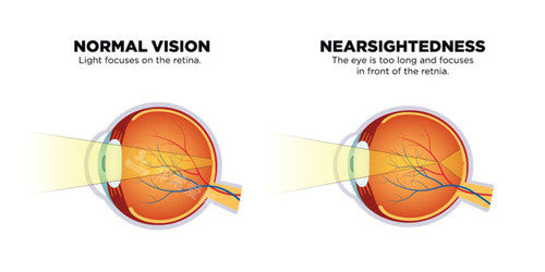 近视眼卡通对比图