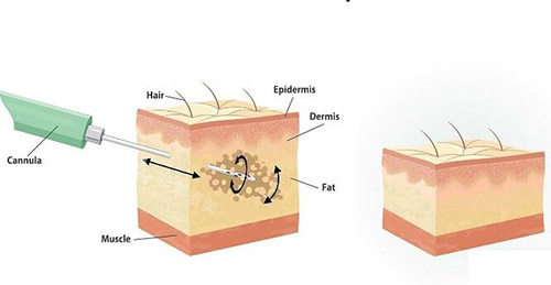 inmode皮肤作用改善图展示 inmode皮肤作用改善图展示