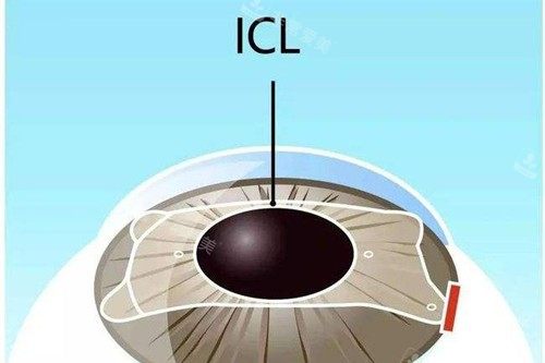 近视眼手术宣传