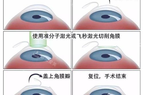 近视眼手术流程展示
