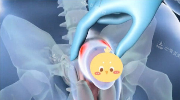 增大增粗手术照片