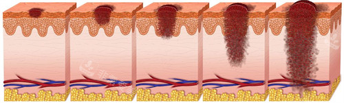 不同深度的疤痕 不同深度的疤痕