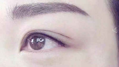 双眼皮实拍 双眼皮实拍