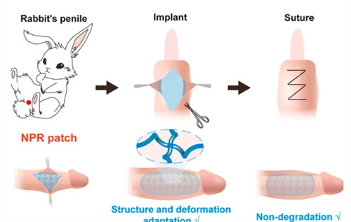 阴茎生物补片演示过程 阴茎生物补片演示过程