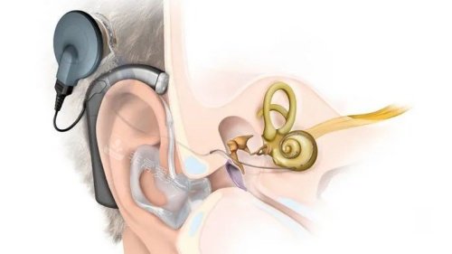 人工耳蜗手术示意图