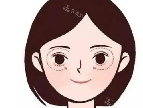 眼角下垂示意图 眼角下垂示意图