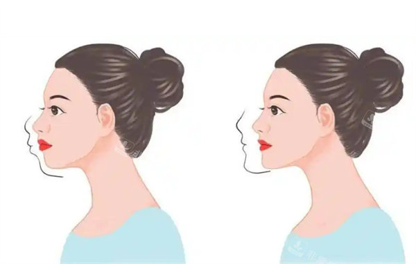 正颌矫正前后对比图