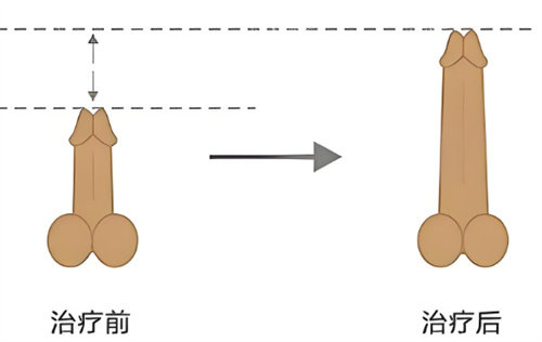 男生增大增粗示意图