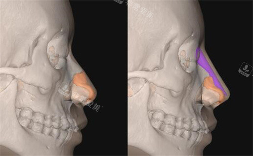 FITme3D鼻假体模拟隆鼻展示
