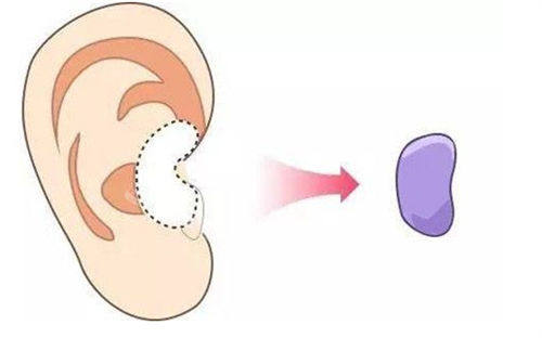 耳软骨隆鼻移除位置展示图