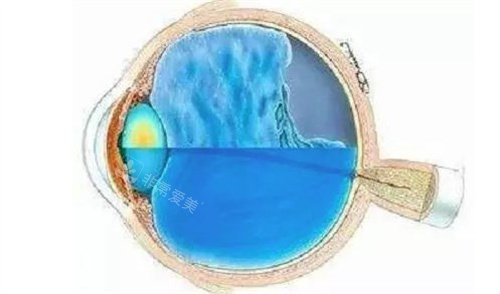 折叠式人工玻璃体球囊