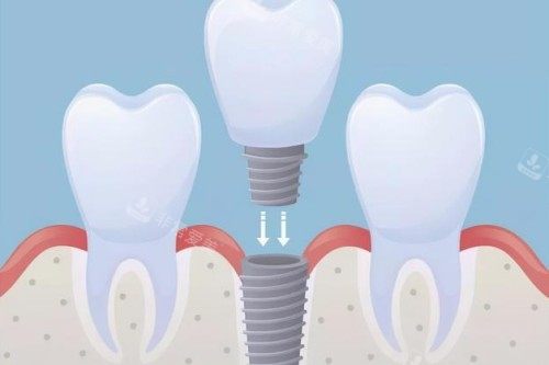 种植体植入卡通图
