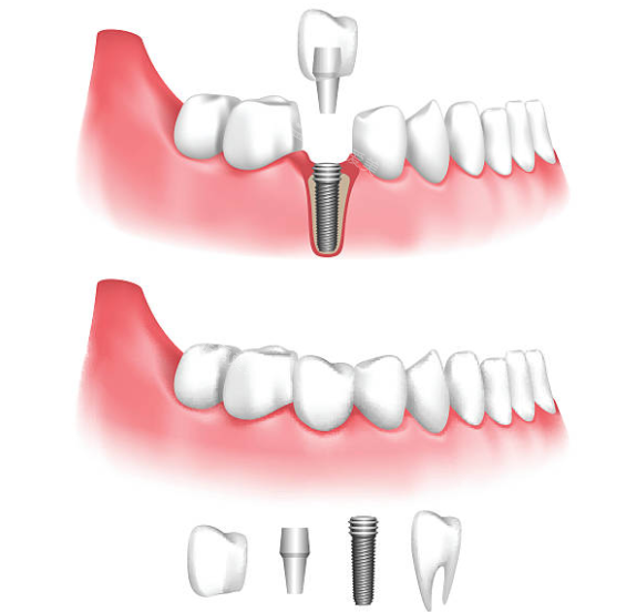 种植牙拆分示意图