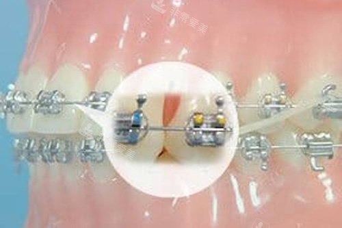 牙齿矫正细节图