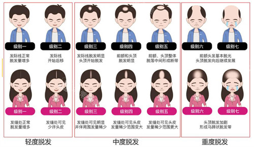 龙岩植发哪家医院好?龙岩毛发移植口碑好的医院推荐毛大夫重森植发!