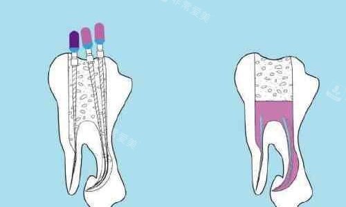 根管治疗手术示意图