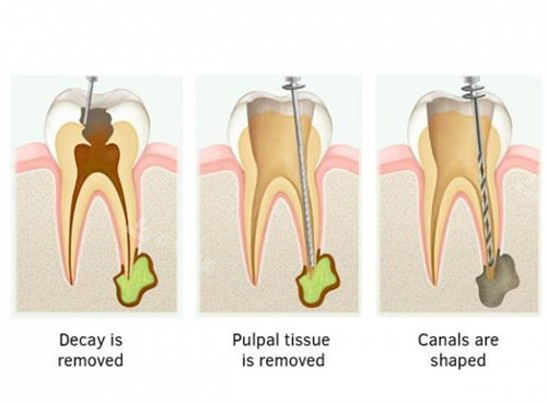 根管治疗步骤图卡通